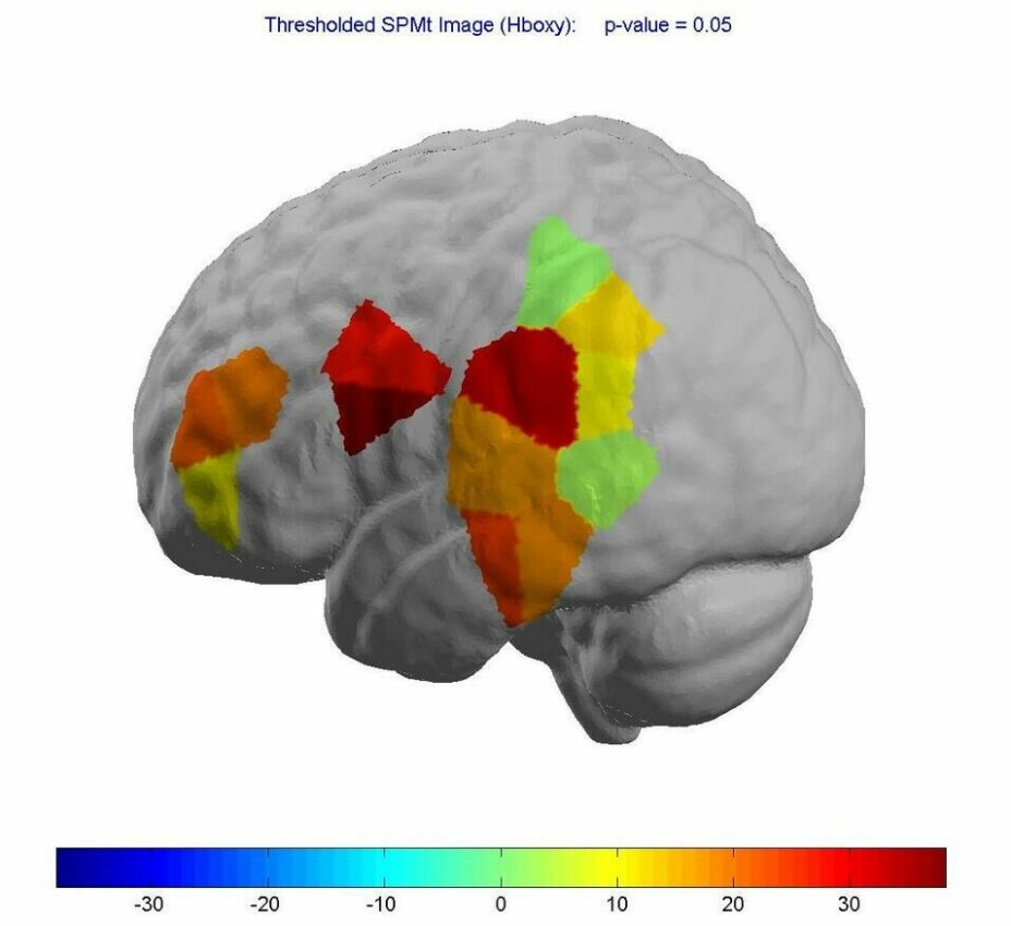 Bildet viser en scanning av hjernen som er gjort mens personen lyttet til språklyder. Vi ser at det er ulike regioner i hjernen som er involvert i denne prosessen. Resultatet er i godt samsvar med teorien om språkprosesser, som tilsier at språkprosessering er en kompleks prosess som involverer flere hjerneområder, spesielt i venstre hjernehalvdel.